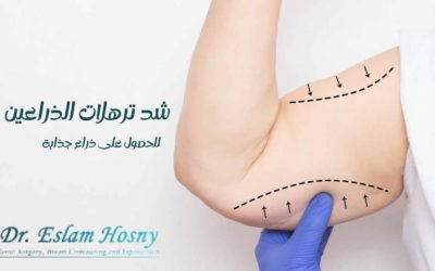 عملية شد ترهلات الذراعين