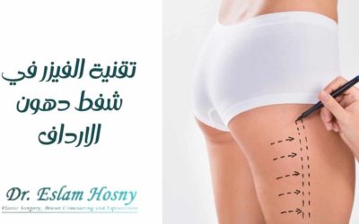 تقنية الفيزر في شفط دهون الارداف