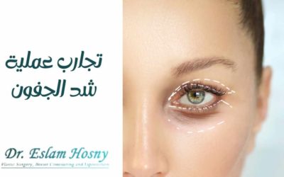 تجارب عملية شد الجفون
