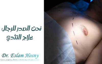 نحت الصدر للرجال | علاج التثدي