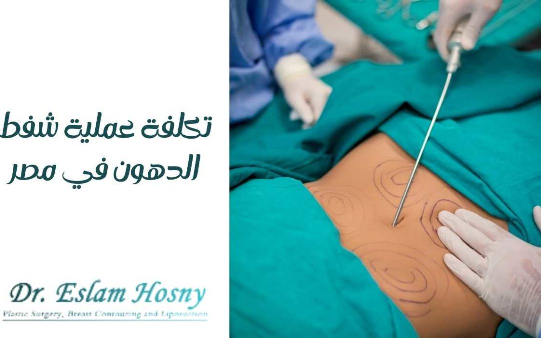 تكلفة عملية شفط الدهون في مصر