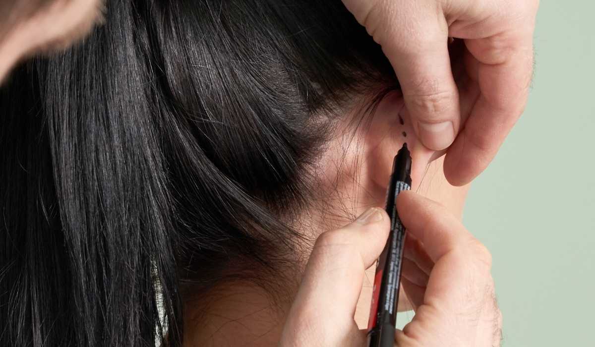 عملية تجميل الأذن 
