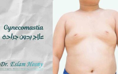 gynecomastia علاج بدون جراحة