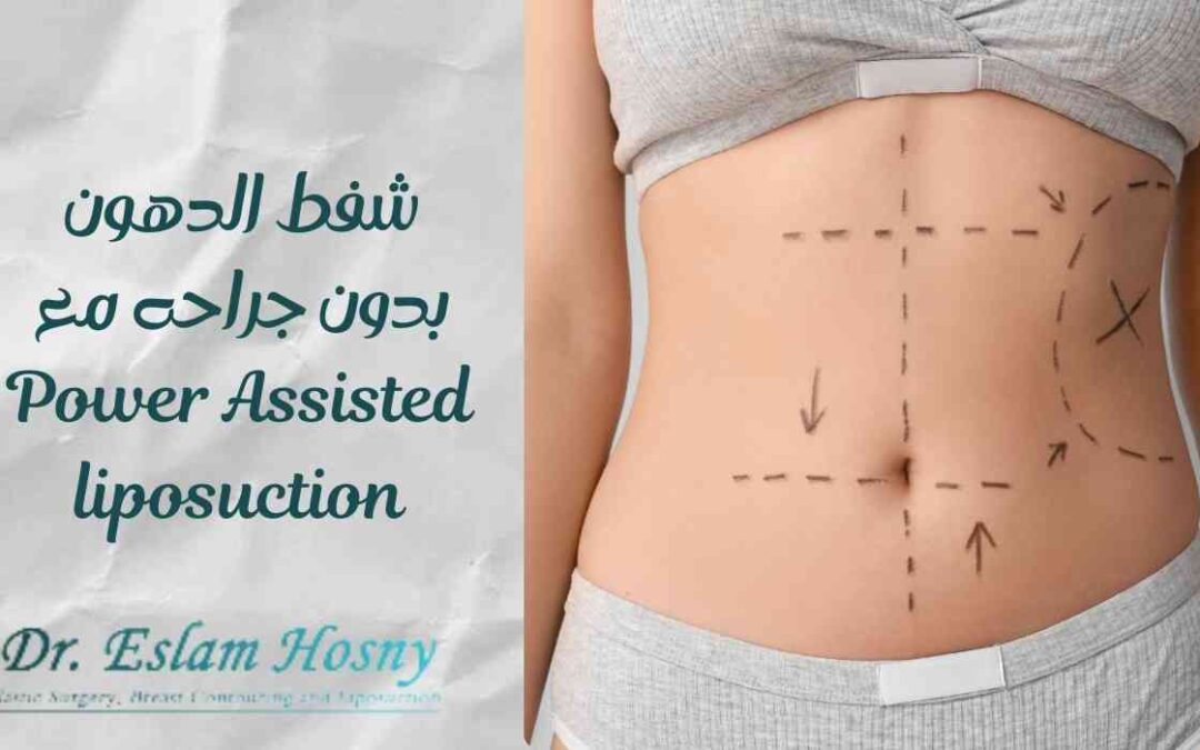 Power-assisted liposuction -PAL- شفط الدهون