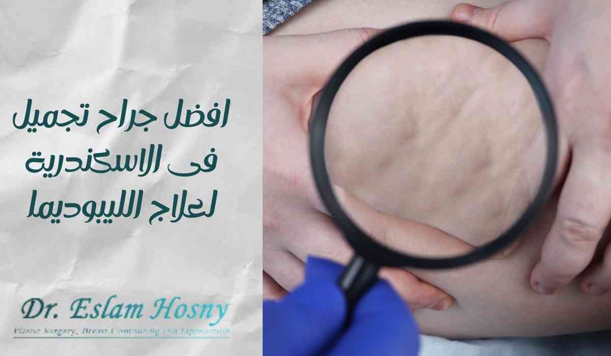 افضل-جراح-تجميل-فى-الاسكندرية-لعلاج-الليبوديما