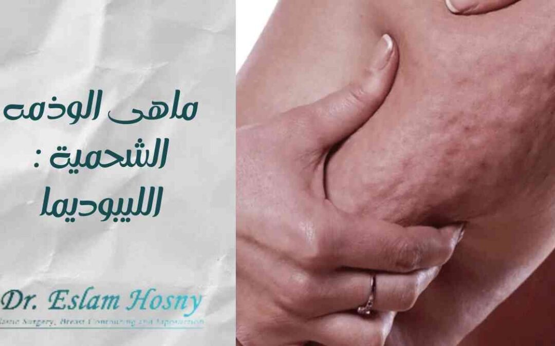 ما هى الوذمه الشحمية: الليبوديما