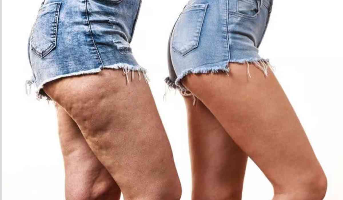 ما-هى-الوذمه-الشحمية-الليبوديما (2) ما-هى-الوذمه-الشحمية-الليبوديما