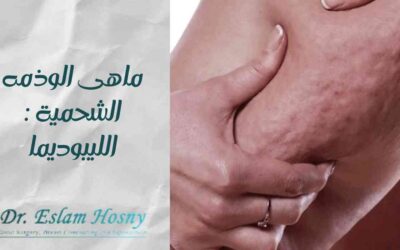 ما هى الوذمه الشحمية: الليبوديما