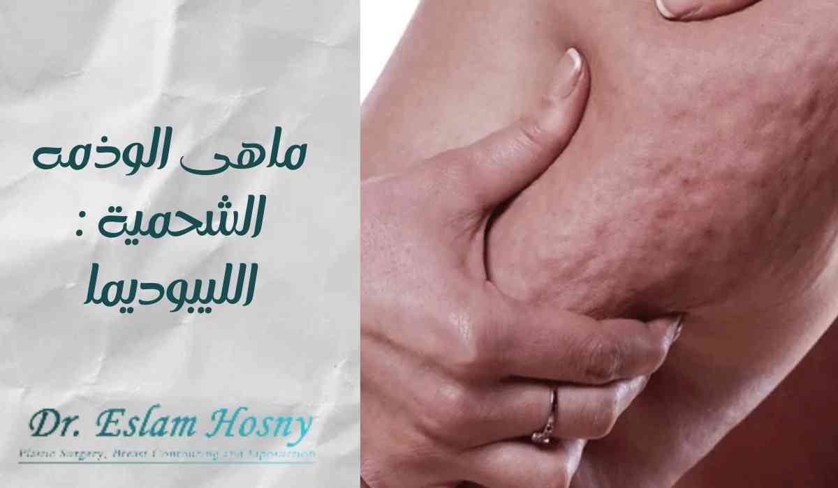 ما-هى-الوذمه-الشحمية-الليبوديما
