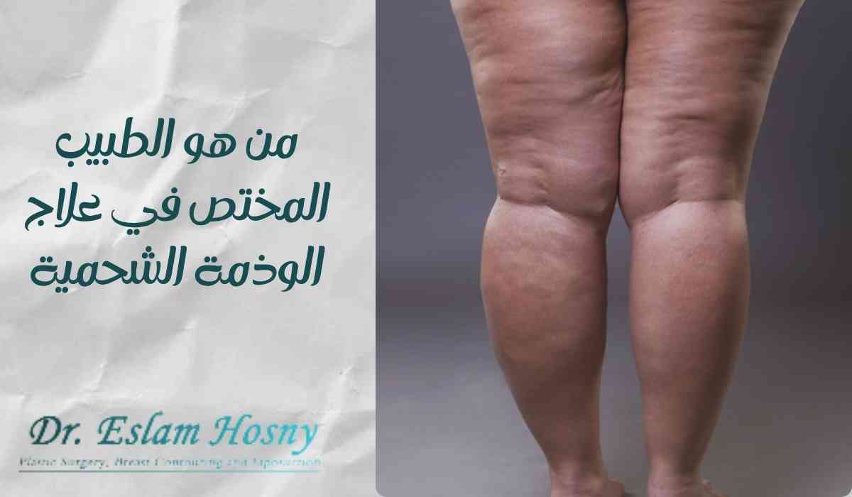 من هو الطبيب المختص في علاج الوذمة الشحمية