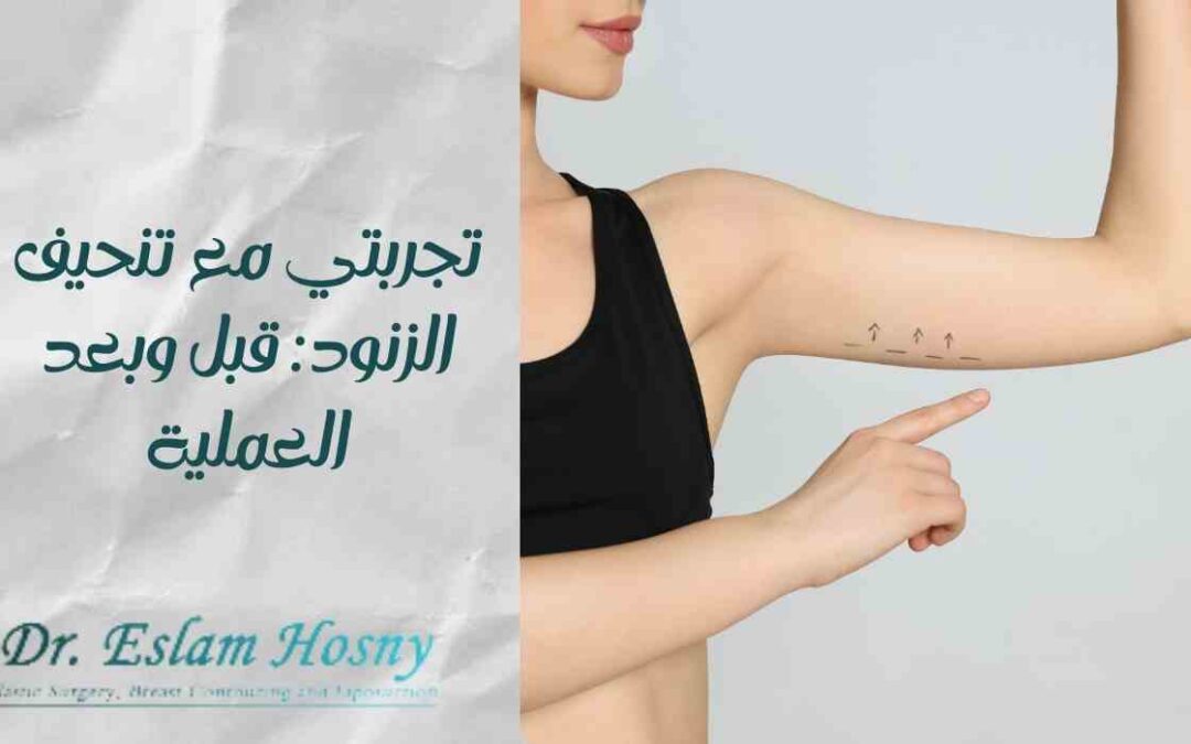 تجربتي مع تنحيف الزنود: قبل وبعد العملية