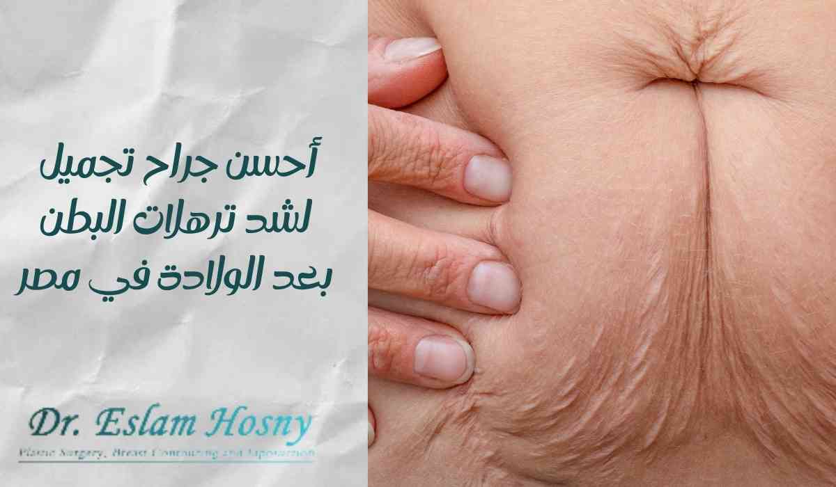 أحسن-جراح-تجميل-شد-ترهلات-البطن-بعد-الولادة