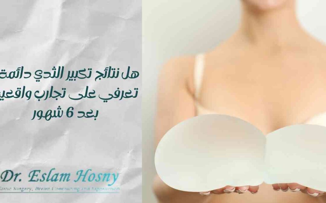 هل نتائج تكبير الثدي دائمة؟ تعرفي على تجارب واقعية بعد 6 شهور