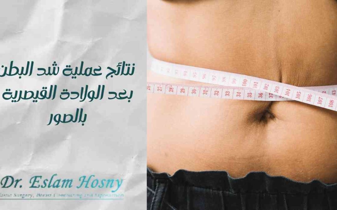 نتائج عملية شد البطن بعد الولادة القيصرية بالصور