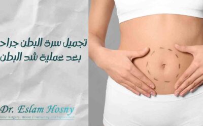 تجميل سرة البطن جراحيا بعد عملية شد البطن