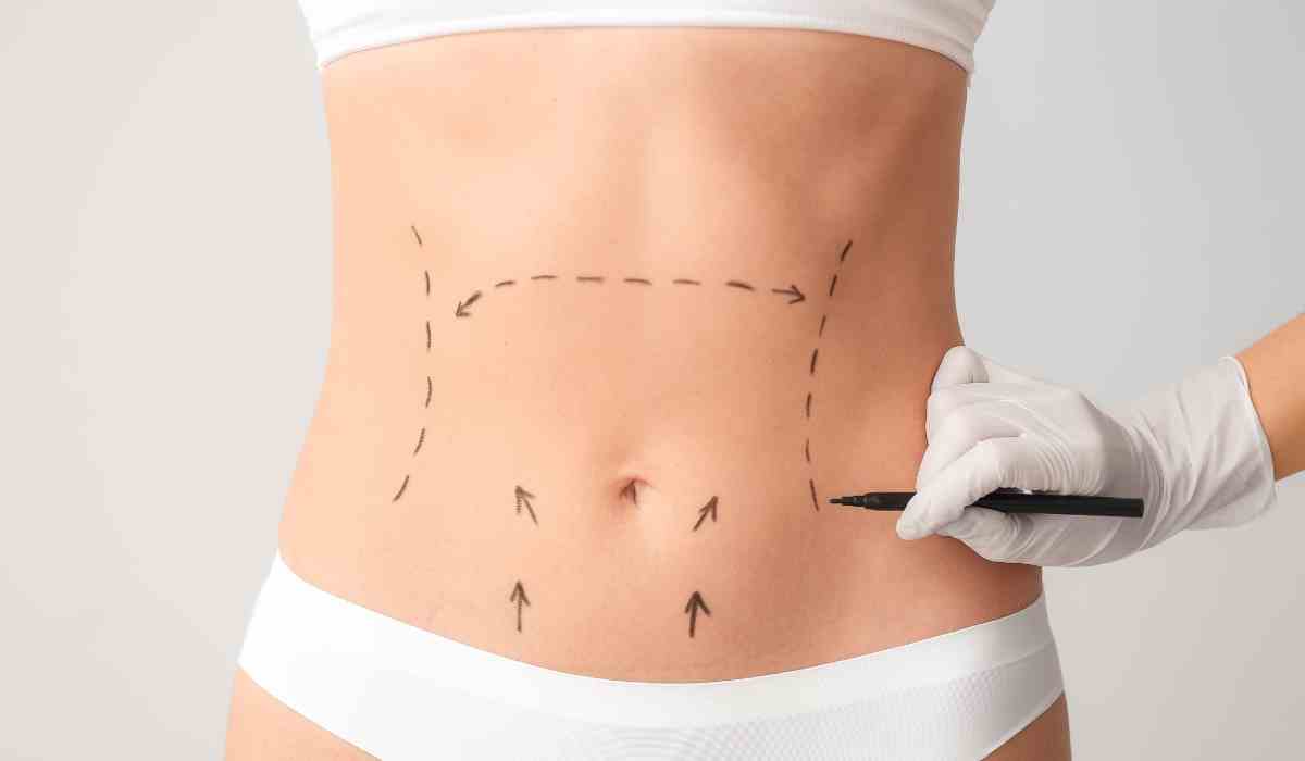 تجميل-سرة-البطن-جراحيا (2) تجميل-سرة-البطن-جراحيا