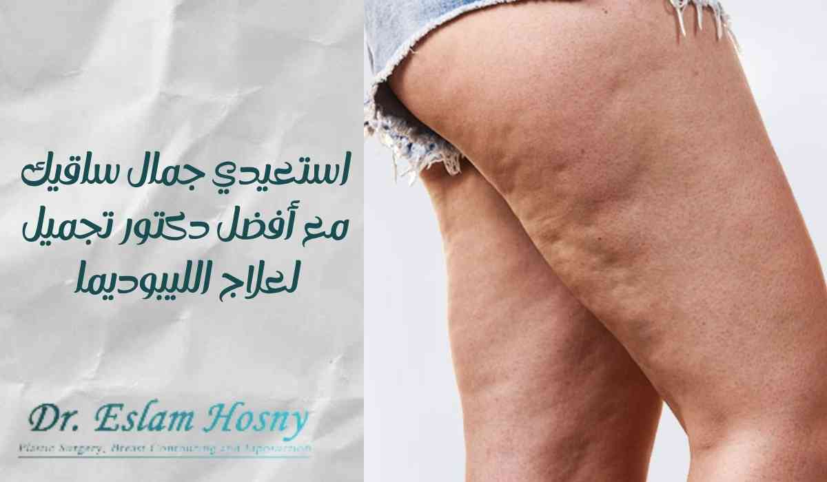 أفضل-دكتور-تجميل-لعلاج-الليبوديما