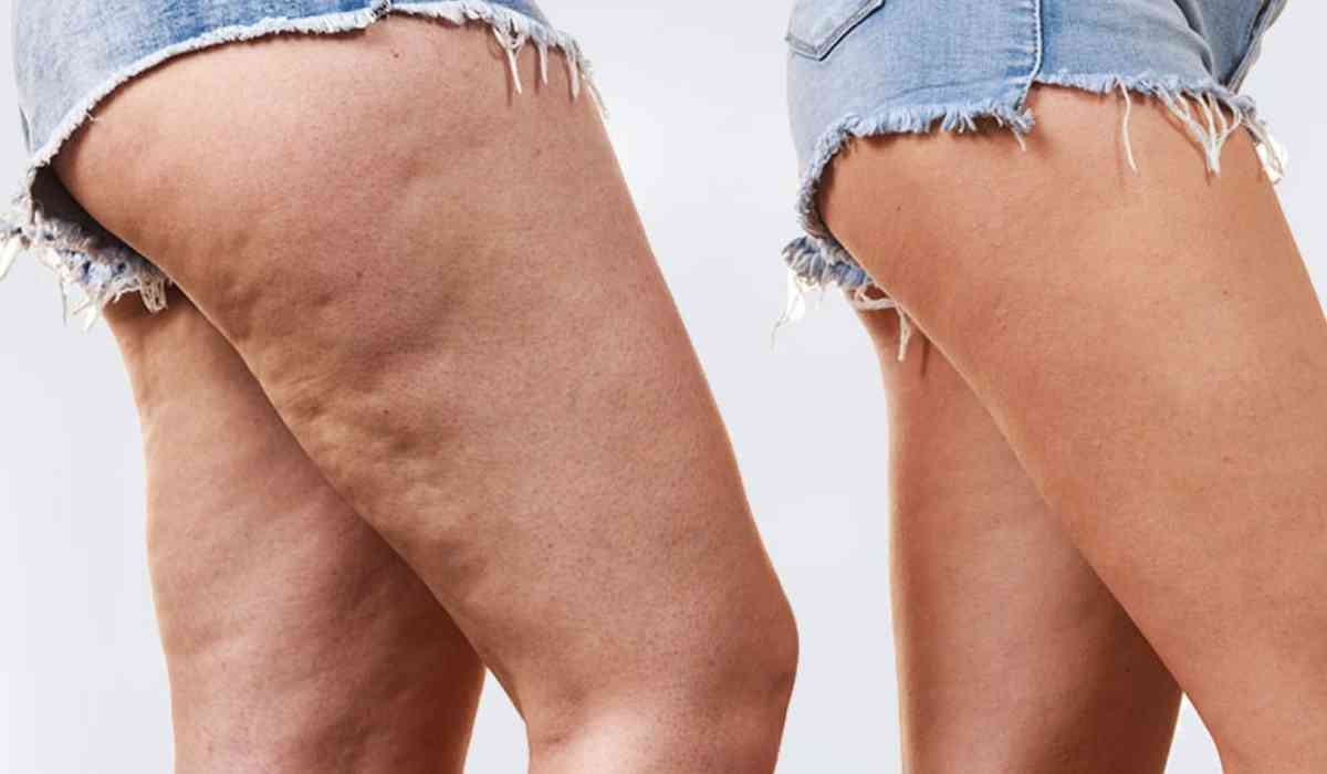 أفضل-دكتور-تجميل-لعلاج-الليبوديما