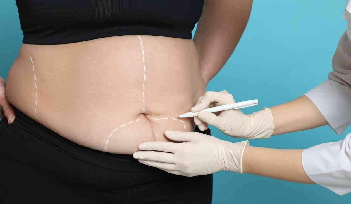 الفرق-بين-شفط-الدهون-وشد-البطن