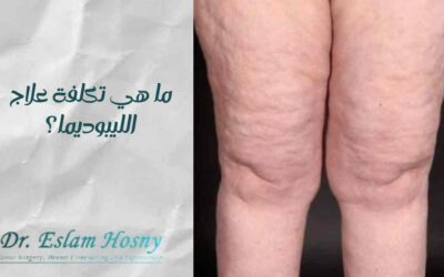 ما هي تكلفة علاج الليبوديما؟