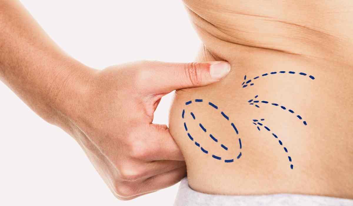 سعر-عملية-شفط-الدهون-في-مصر-2026