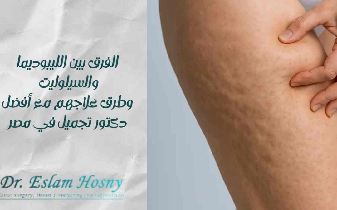 الفرق بين الليبوديما والسيلوليت وطرق علاجهم مع أفضل دكتور تجميل في مصر