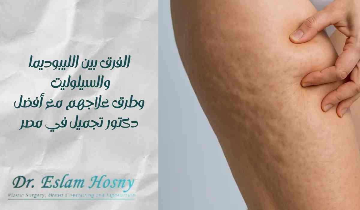 الفرق-بين-الليبوديما-والسيلوليت