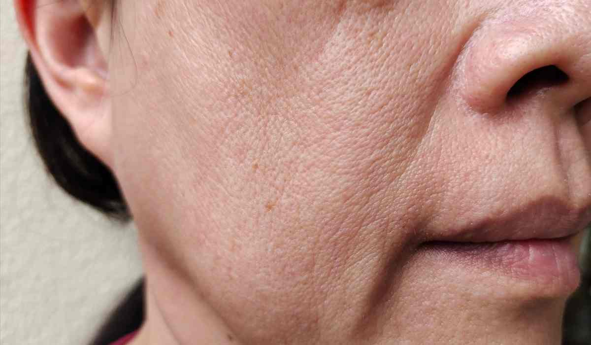 تجربتي-في-علاج-ترهل-الوجه