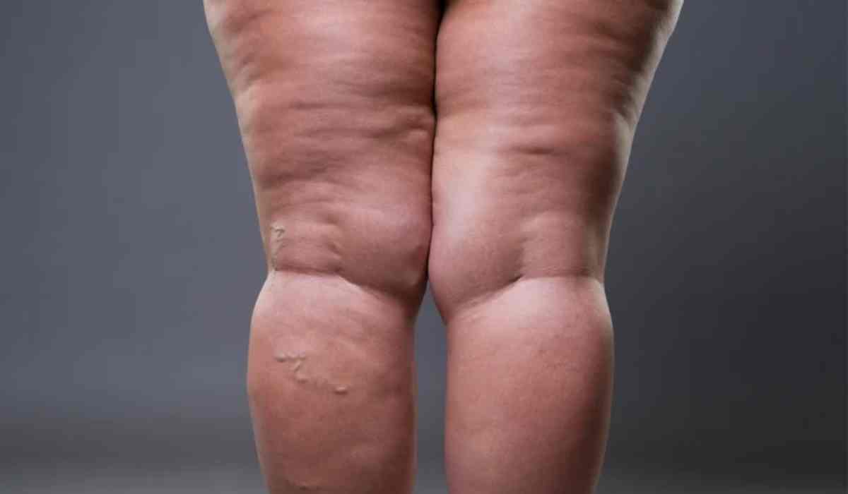 علاج-الليبوديما-بدون-جراحة