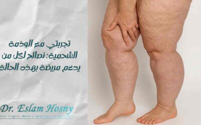 تجربتي مع الوذمة الشحمية: نصائح لكل من يدعم مريضة بهذه الحالة