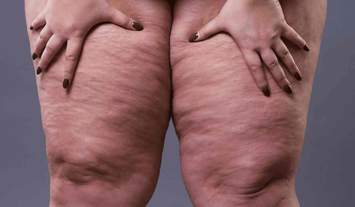 تجربتي-مع-الوذمة-الشحمية