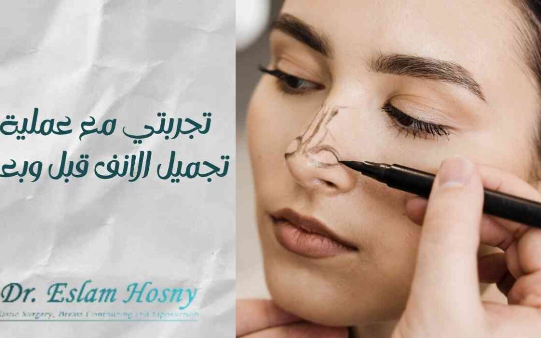 تجربتي مع عملية تجميل الانف قبل وبعد