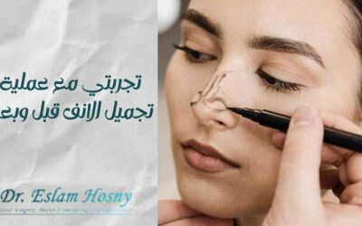 تجربتي مع عملية تجميل الانف قبل وبعد