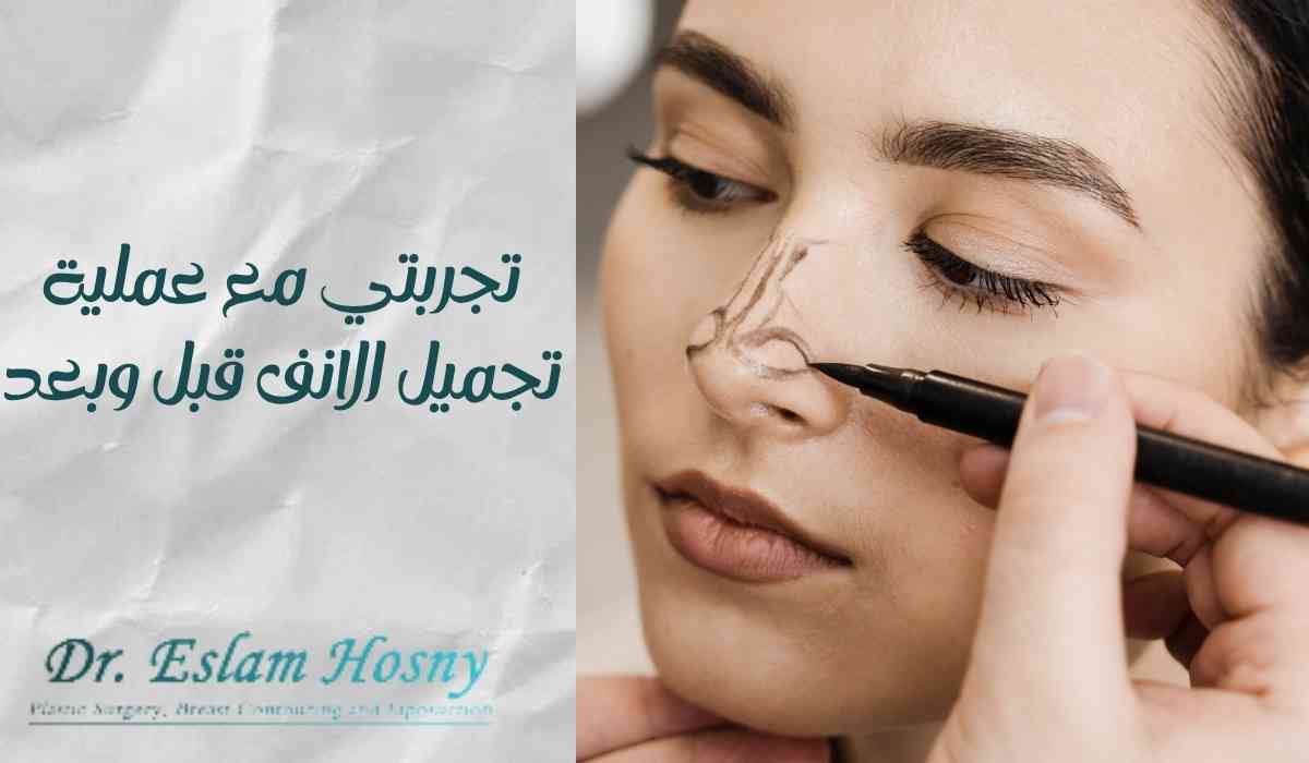 تجميل-الانف-قبل-وبعد