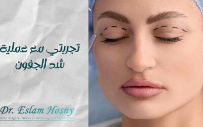 تجربتي مع عملية شد الجفون