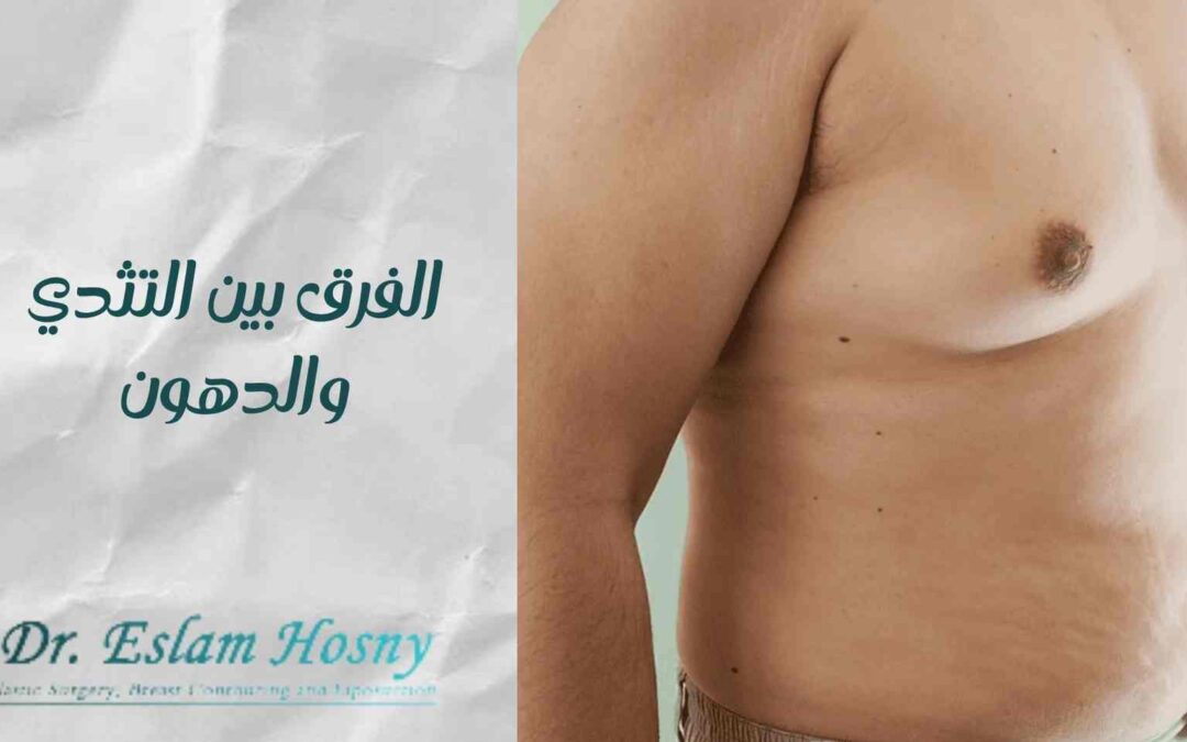 الفرق بين التثدي والدهون