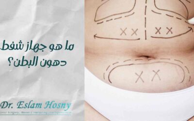 جهاز شفط دهون البطن