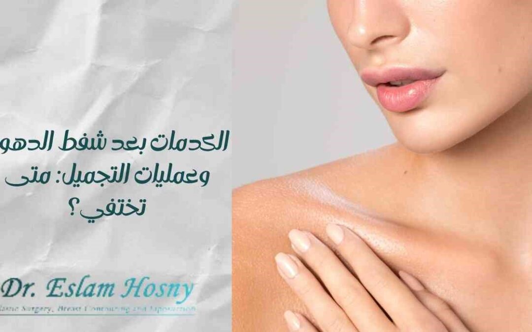 الكدمات بعد شفط الدهون وعمليات التجميل: متى تختفي؟
