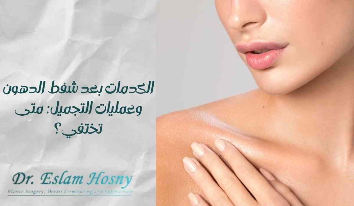 الكدمات بعد شفط الدهون وعمليات التجميل: متى تختفي؟