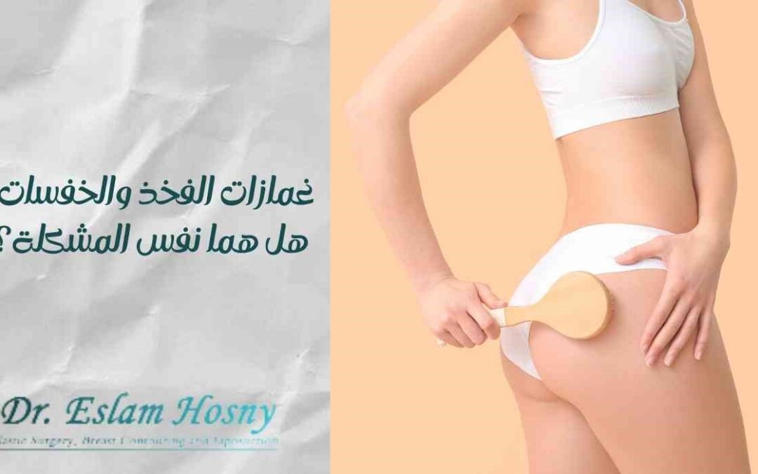 غمازات الفخذ والخفسات: هل هما نفس المشكلة؟