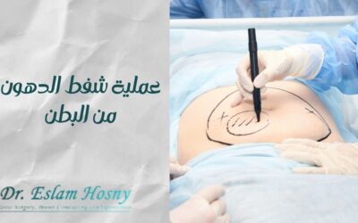 عملية شفط الدهون من البطن​