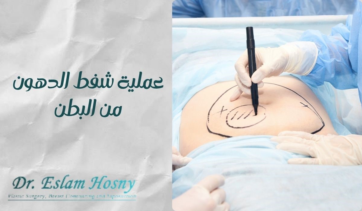 عملية شفط الدهون من البطن​