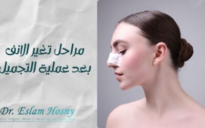مراحل تغير الأنف بعد عملية التجميل
