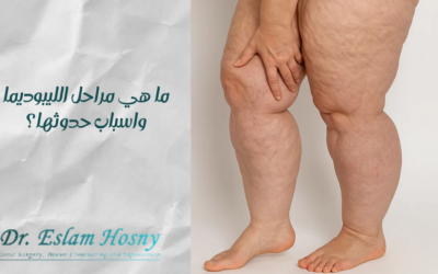 ما هي مراحل الليبوديما واسباب حدوثها؟