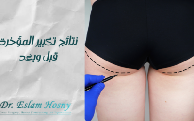 نتائج تكبير المؤخرة قبل وبعد